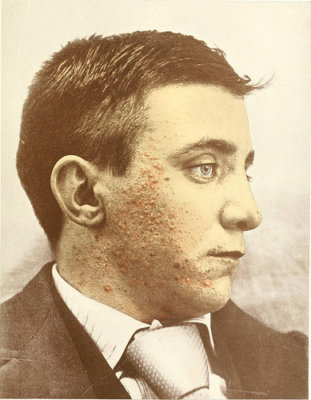 male acne